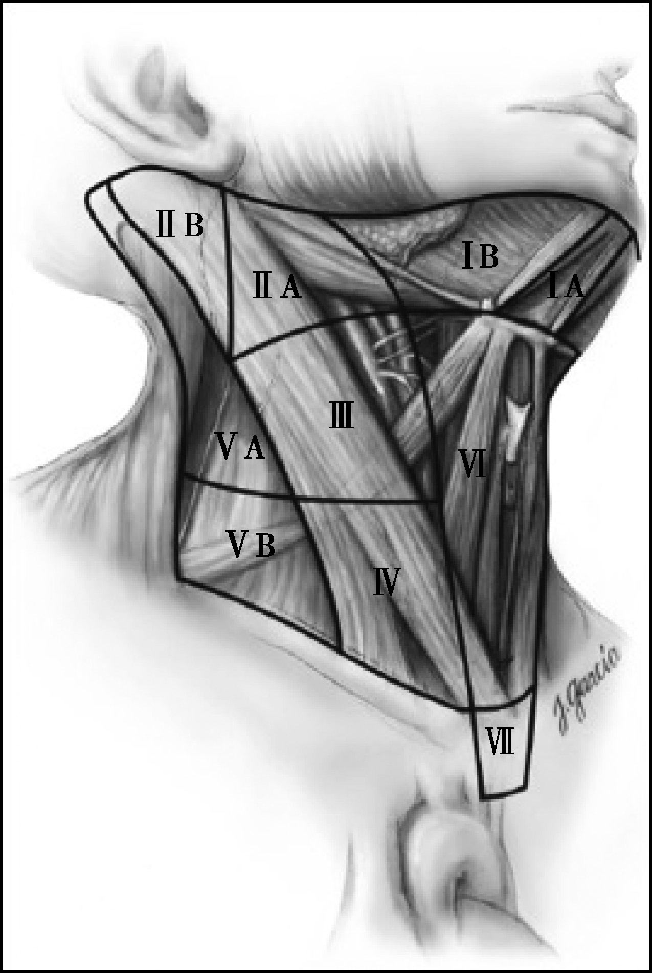 图1 颈部淋巴结分区示意图