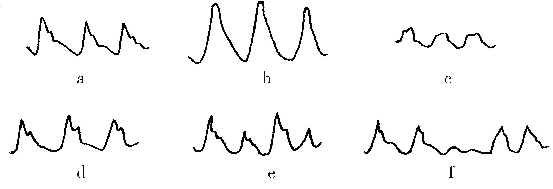 各种脉波波形 a. 正常脉波b.水冲脉c.迟脉d.重搏脉e.交替脉f.