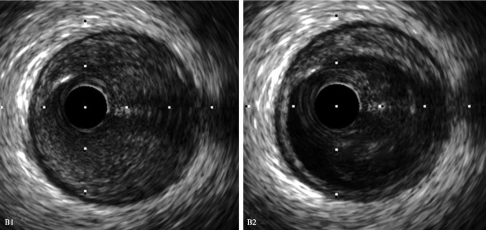 血管内超声最新章节_葛均波著