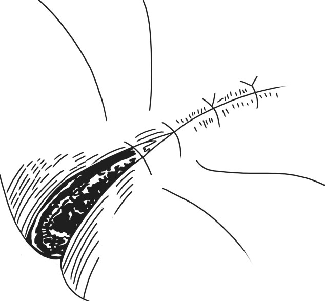 图2-33 间断垂直褥式内翻缝合