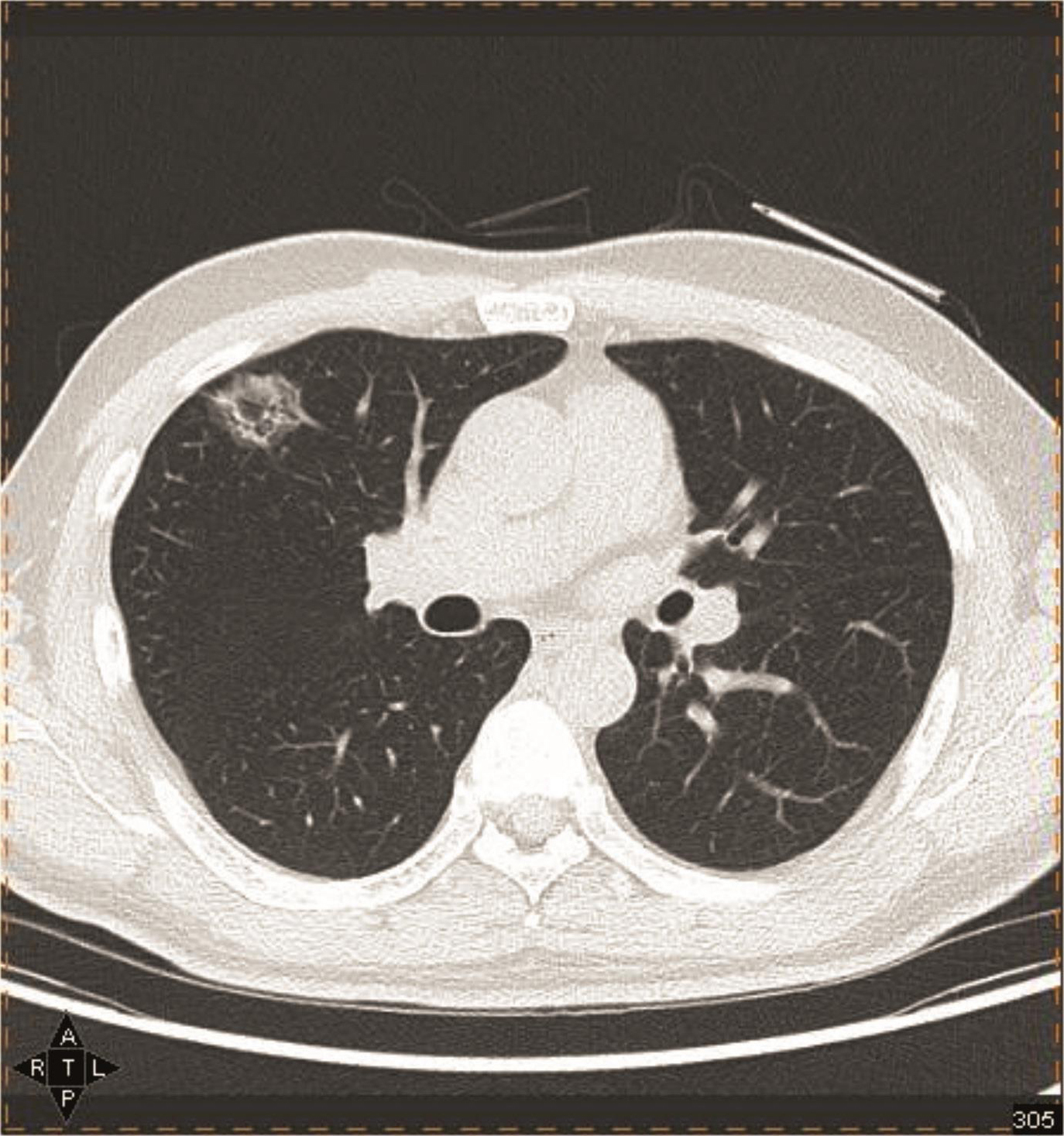 图2-7-9 pet/ct:3年后左上肺