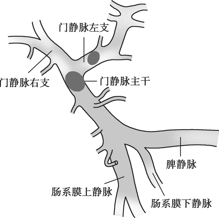 门静脉系统血栓分型