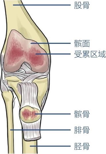 股骨髌面受累区域髌骨腓骨胫骨