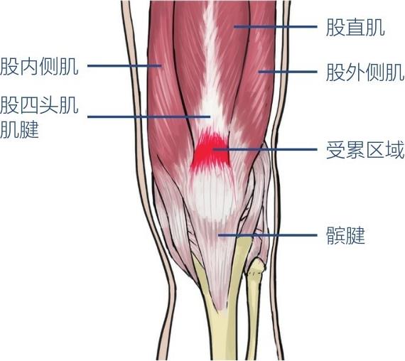 股内侧肌股四头肌肌腱股直肌股外侧肌受累区域髌腱