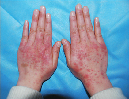 干燥综合征腺体外损伤