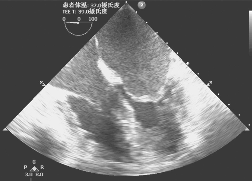 圖1-32 二尖瓣狹窄換瓣術前