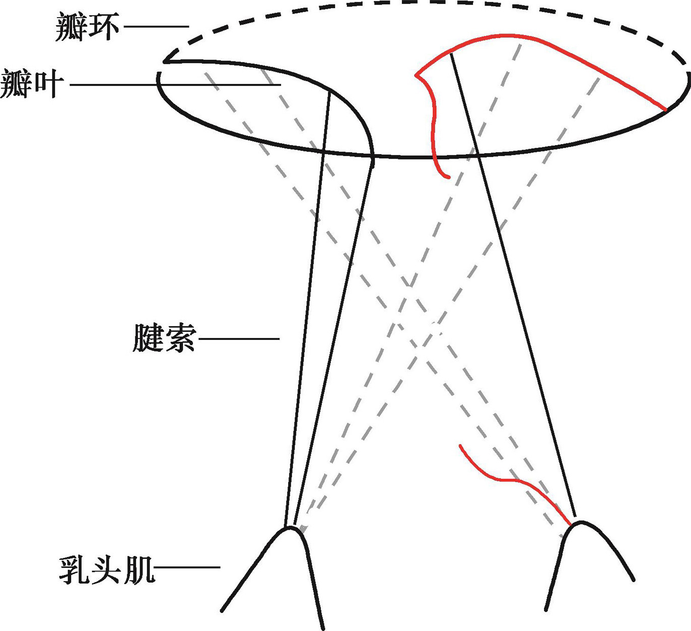 1)carpentierⅠ型反流(图1-34):          二尖瓣叶运动正常,瓣环扩大